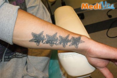 Przed zabiegiem laserowego usunięcia tatuażu na ręce