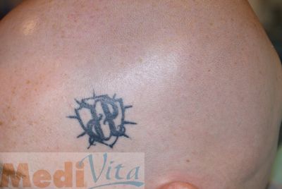 Przed zabiegiem laserowego usunięcia tatuażu na głowie