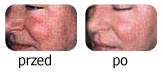 pacjentka przed i po fotoodmładzaniu skóry